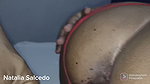 Premature ejaculation
